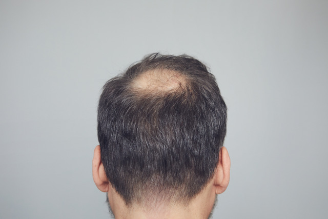 Masterklinikken Arvelig Haartap